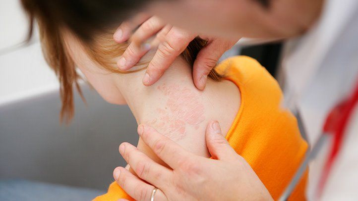 What’s the Best Treatment for Eczema?