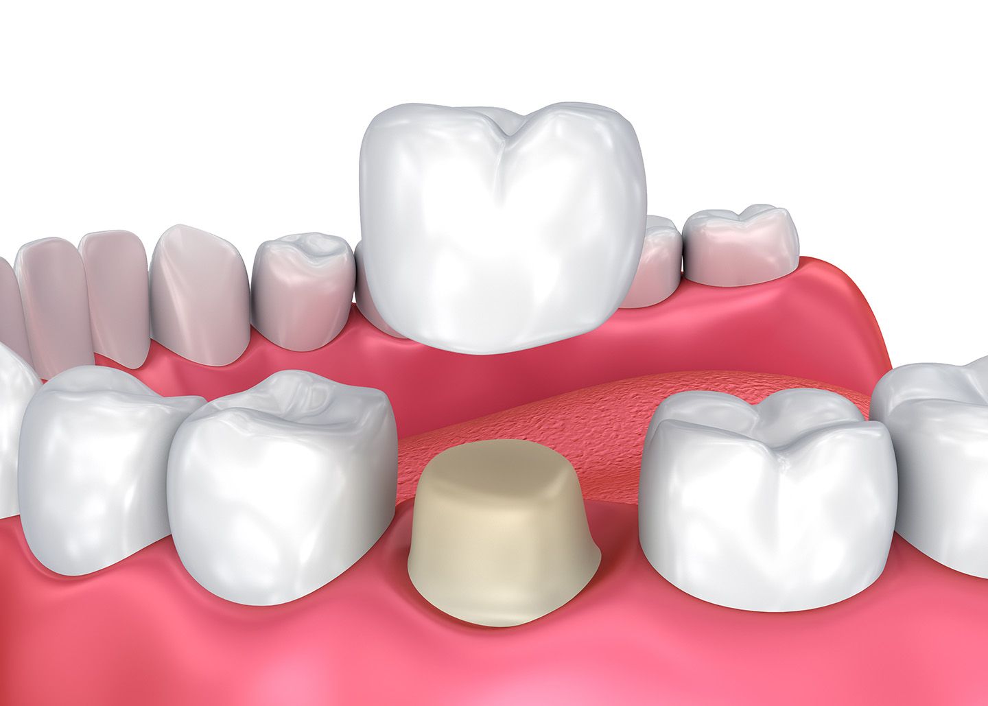 Unlocking the Power of Dental Crowns: A Comprehensive Guide