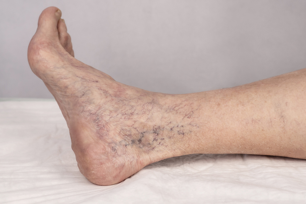 Your Comprehensive Varicose Veins Guide